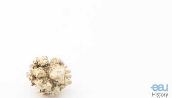 Bladder stone “Sputnik”