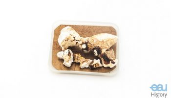 Renal calculi “Koralle”