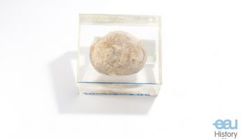 Bladder stone